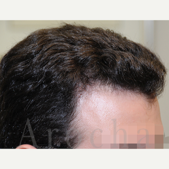 Gentleman in late twenties treated with FUSS Hair Transplant after 3320574