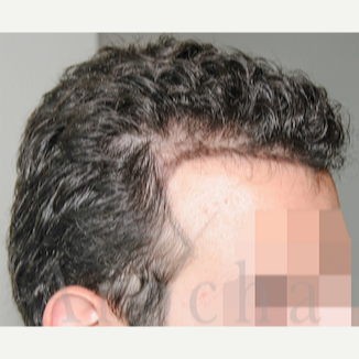 Gentleman in late twenties treated with FUSS Hair Transplant before 3320574