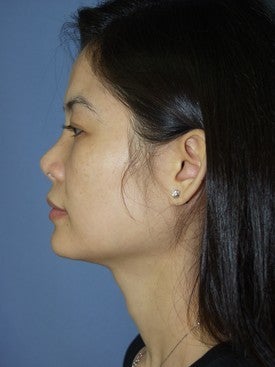 25-34 year old woman treated with Revision Rhinoplasty 1621130