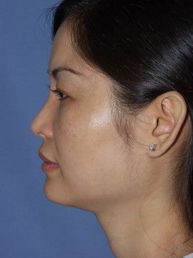 25-34 year old woman treated with Revision Rhinoplasty 1621130