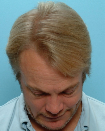 35-44 year old man treated with FUE Hair Transplant after 1728041