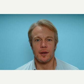 35-44 year old man treated with FUE Hair Transplant 1728041