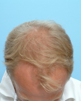 35-44 year old man treated with FUE Hair Transplant before 1728041