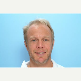 35-44 year old man treated with FUE Hair Transplant 1728041