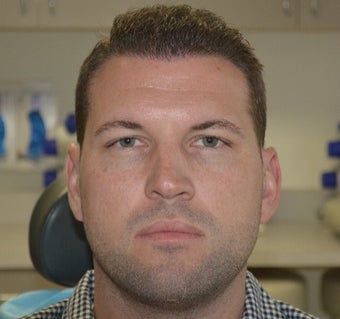 35-44 year old man treated with FUE Hair Transplant after 3065687