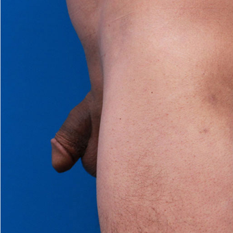 35-44 year old man treated with Penis Enlargement before 3179453