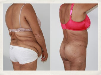 Liposculpture and tummy tuck 1218234