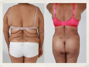 Liposculpture and tummy tuck 1218234