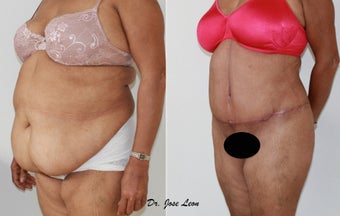 Liposculpture and tummy tuck after 1218234