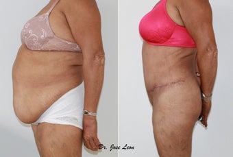 Liposculpture and tummy tuck before 1218234