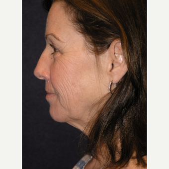 55-64 year old woman treated with Facelift before 3466660