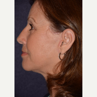 55-64 year old woman treated with Facelift after 3466660