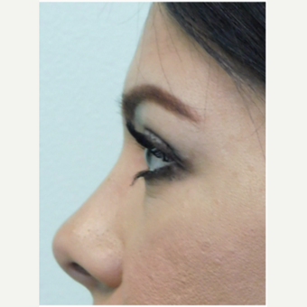 35-44 year old woman treated with Brow Lift and Upper Blepharoplasty (Eyelid Lift) after 3670888