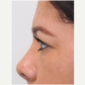 35-44 year old woman treated with Brow Lift and Upper Blepharoplasty (Eyelid Lift) before 3670888