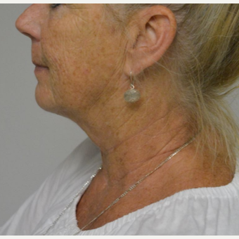 55-64 year old woman treated with Kybella after 3213837