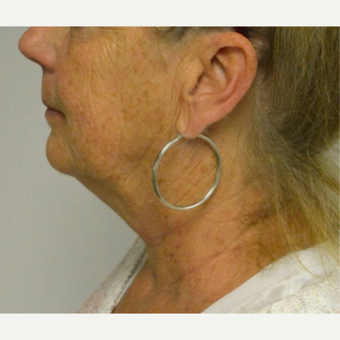 55-64 year old woman treated with Kybella before 3213837