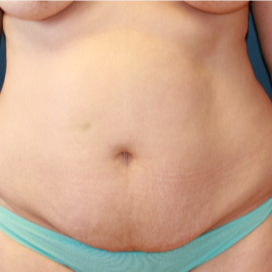 32 yr old mother of two four months after abdominoplasty (tummy tuck) before 3202974