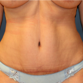 32 yr old mother of two four months after abdominoplasty (tummy tuck) after 3202974