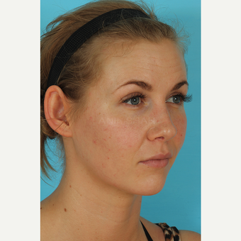 25-34 year old woman treated with Rhinoplasty after 3629417