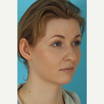 25-34 year old woman treated with Rhinoplasty before 3629417