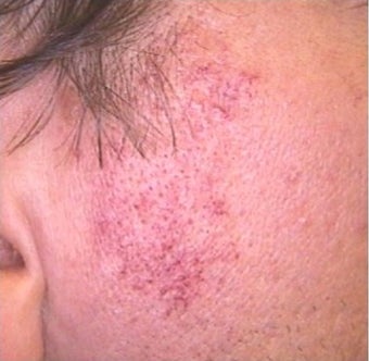 35-44 year old woman treated with IPL before 2119803