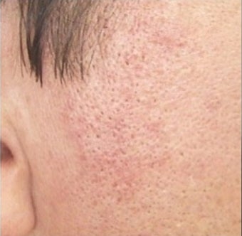 35-44 year old woman treated with IPL after 2119803