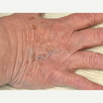 65-74 year old woman treated with IPL before 3295311