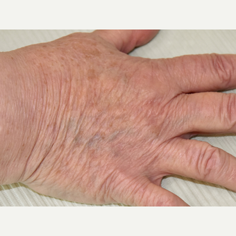 65-74 year old woman treated with IPL after 3295311