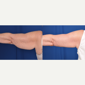 65-74 year old woman treated with Arm Lift before 3538464