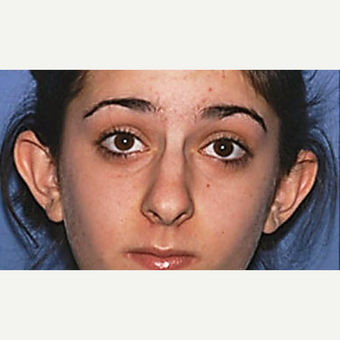 18-24 year old woman treated with Ear Surgery before 3090727