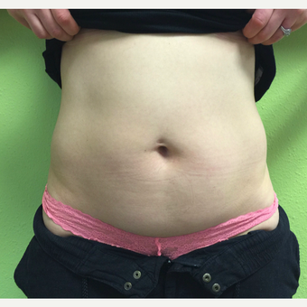 35-44 year old woman treated with Vanquish before 3725460