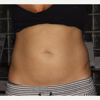 35-44 year old woman treated with Vanquish after 3725460
