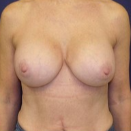 Breast Augmentation after 1568969