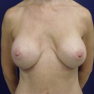 Breast Augmentation before 1568969