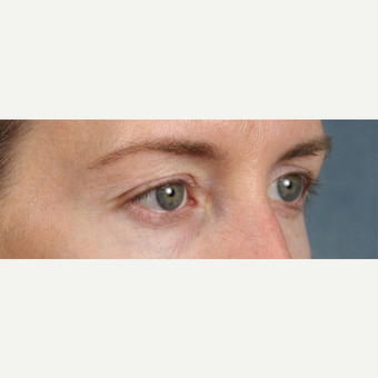 Eyelid Surgery before 3123710