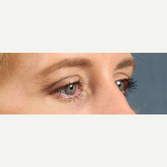 Eyelid Surgery after 3123710