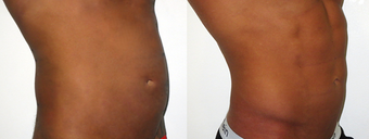 25-34 year old man treated with Vaser Liposuction before 4599311