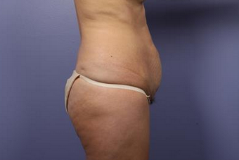 45-54 year old woman treated with Tummy Tuck before 1677584
