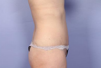 45-54 year old woman treated with Tummy Tuck after 1677584