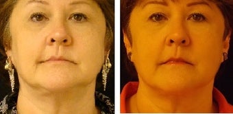 Venus Freeze Skin Tightening for Face & Neck before 1090854