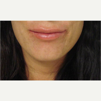 35-44 year old woman treated with Lip Augmentation before 3391177