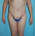Bodylift after Massive Weightloss after 1074028
