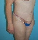 Bodylift after Massive Weightloss 1074028