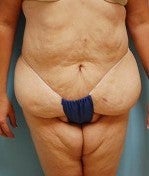 Bodylift after Massive Weightloss before 1074028