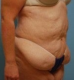 Bodylift after Massive Weightloss 1074028