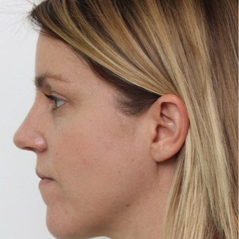 25-34 year old woman treated with Rhinoplasty after 3425592