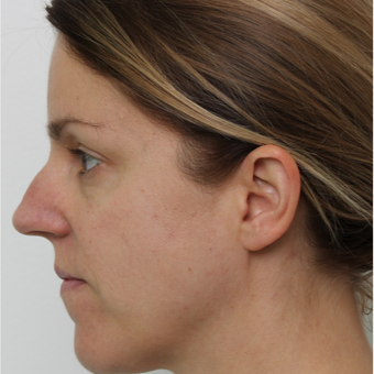 25-34 year old woman treated with Rhinoplasty before 3425592