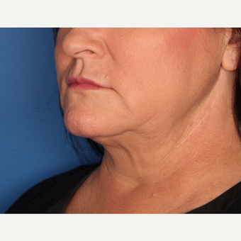 45-54 year old woman treated with Kybella after 3715182