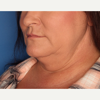 45-54 year old woman treated with Kybella before 3715182