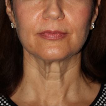 61 year old woman treated with Facelift 5 weeks post-op before 3419008